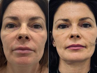 Blefaroplastia antes y después - 870354