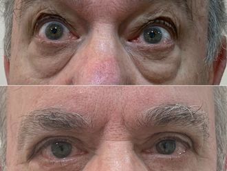 Blefaroplastia antes y después - 870358