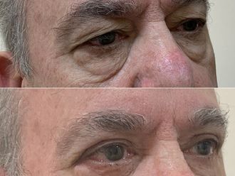 Blefaroplastia antes y después - 870359