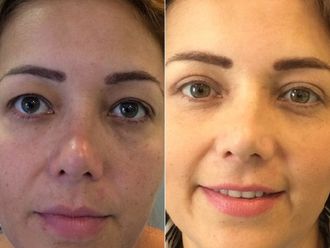 Blefaroplastia antes y después - 870360