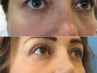 Blefaroplastia antes y después - 870361