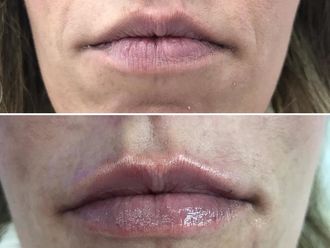 Aumento labios - 632754