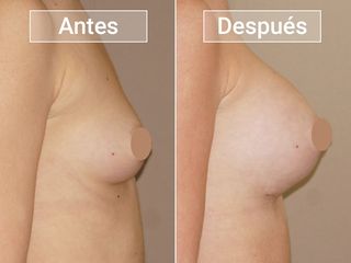 Antes y después Aumento de pecho