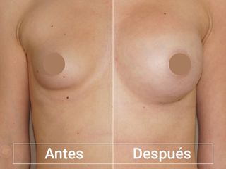 Antes y después Aumento de pecho