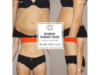 Antes y después Mommy makeover