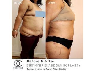 Antes y después Abdominoplastia