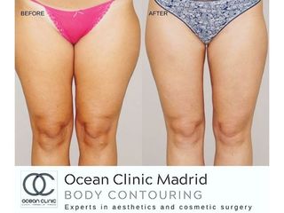 Antes y después Liposucción