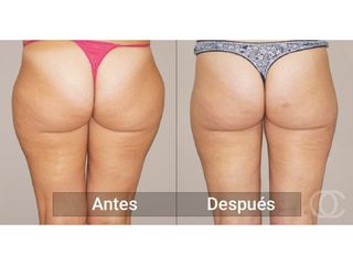 Antes y después Liposucción