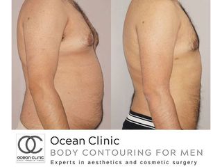 Antes y después Abdominoplastia