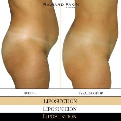 Liposucción - Ocean Clinic Madrid