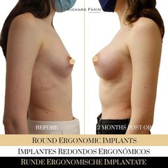 Aumento de pecho - Ocean Clinic Madrid