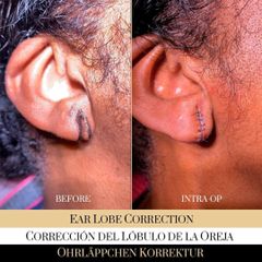 Lobuloplastia - Ocean Clinic Madrid