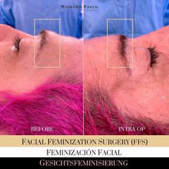 Feminizacion Facial - Ocean Clinic Madrid