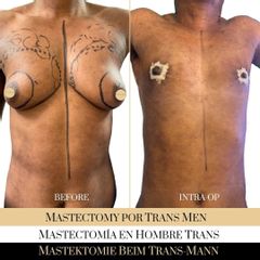 Cambio de sexo - Ocean Clinic Madrid