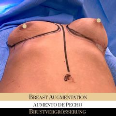 Aumento de pecho - Ocean Clinic Madrid