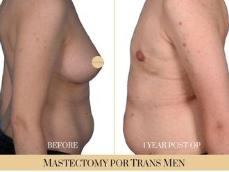 Cambio de sexo antes y después - 740315