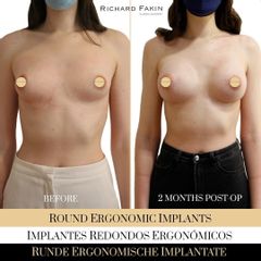 Aumento de pecho - Ocean Clinic Madrid