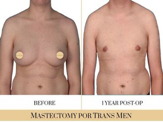 Cambio de sexo antes y después - 740319