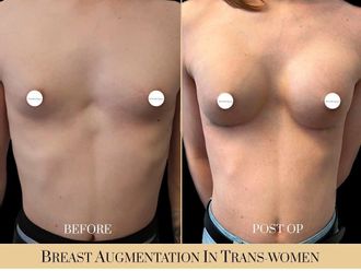 Cambio de sexo antes y después - 816722