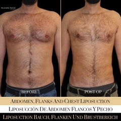 Liposucción - Ocean Clinic Madrid