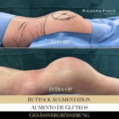 Aumento de glúteos - Ocean Clinic Madrid