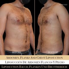 Liposucción - Ocean Clinic Madrid