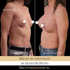 Aumento de pecho - Ocean Clinic Madrid
