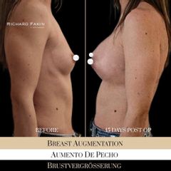 Aumento de pecho - Ocean Clinic Madrid