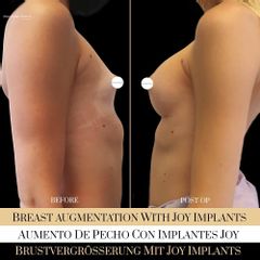 Aumento de pecho - Ocean Clinic Madrid