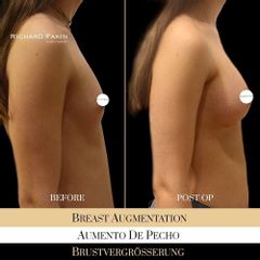 Aumento de pecho - Dr. Richard Fakin