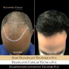 Trasplante capilar técnica FUE  - Dr. Richard Fakin