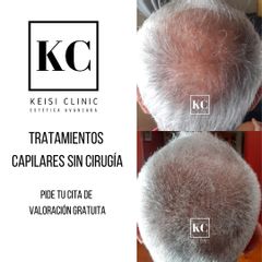 Tratamiento capilar - Keisi Clinic