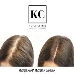 Mesoterapia - Keisi Clinic