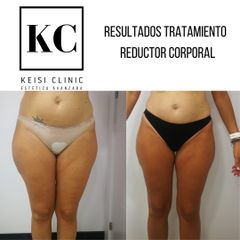 Cavitación - Keisi Clinic