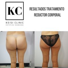 Cavitación - Keisi Clinic