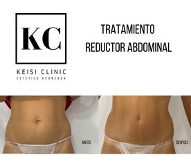 Cavitación - Keisi Clinic