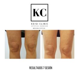 Cavitación - Keisi Clinic