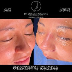 Rinoplastia - Dr. Jorge Noguera