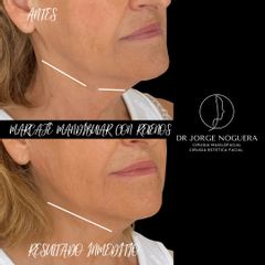 Rellenos faciales - Dr. Jorge Noguera