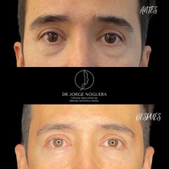 Eliminación ojeras - Dr. Jorge Noguera
