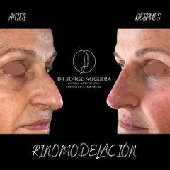 Rinomodelación - Dr. Jorge Noguera