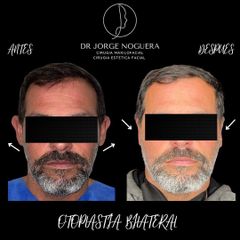 Otoplastia - Dr. Jorge Noguera