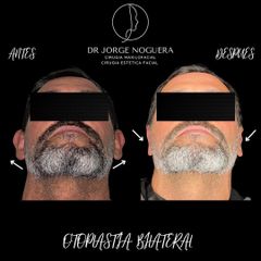 Otoplastia - Dr. Jorge Noguera