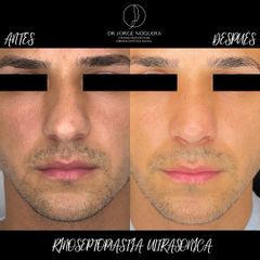 Rinoplastia - Dr. Jorge Noguera