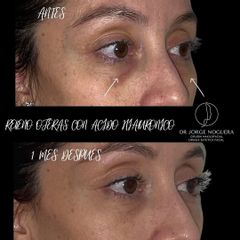 Eliminar ojeras - Dr. Jorge Noguera