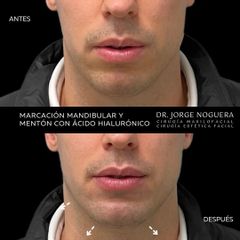 Marcación mandibular - Dr. Jorge Noguera
