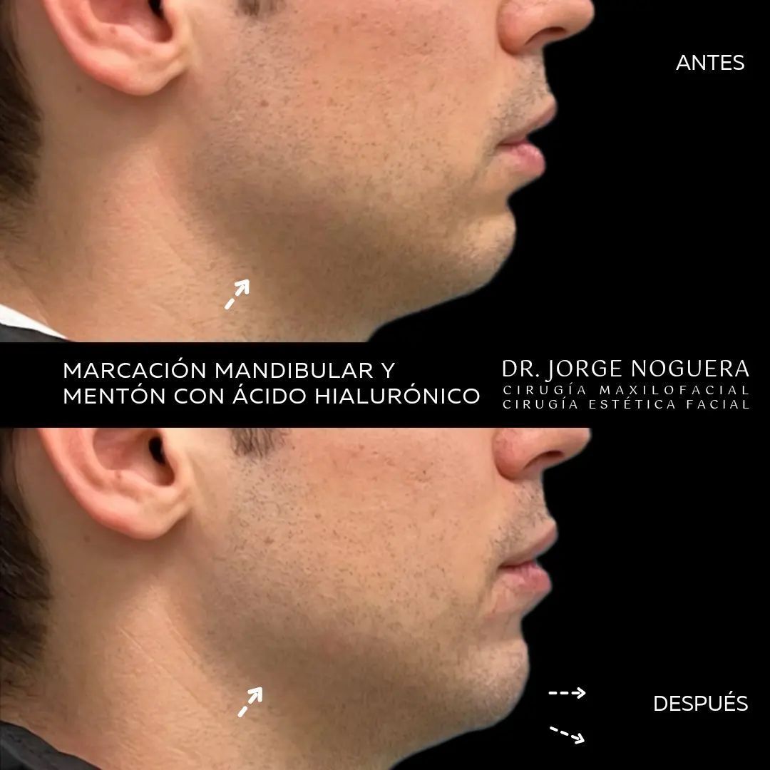 Aumento mentón Antes y después - Multiestetica.com - Multiestetica.com