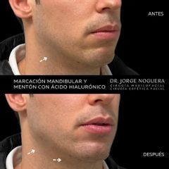 Marcación mandibular - Dr. Jorge Noguera