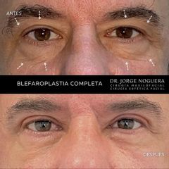 Blefaroplastia - Dr. Jorge Noguera