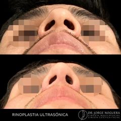 Rinoplastia - Dr. Jorge Noguera